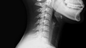 Spine Motion Analysis
